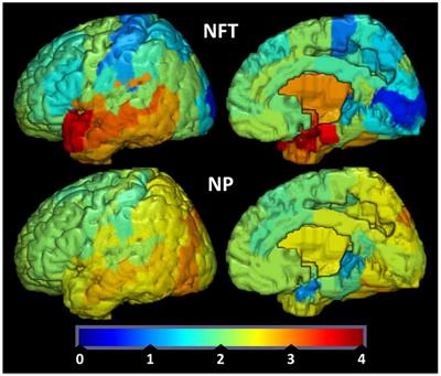 Insulin Resistance as a Link between Amyloid-Beta and Tau Pathologies in Alzheimer’s Disease